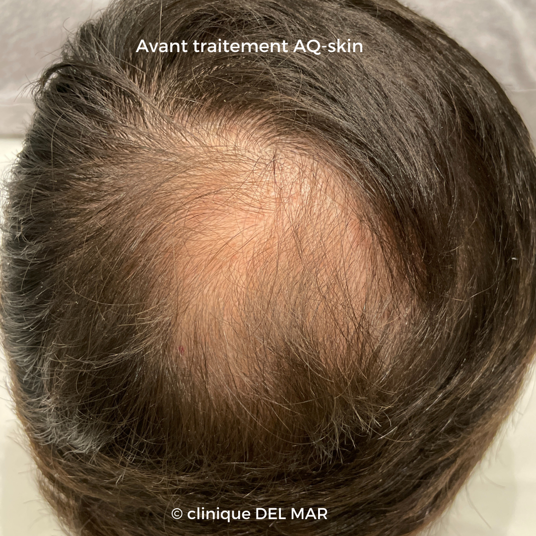 AQ skin traitement cheveux clinique delmar
