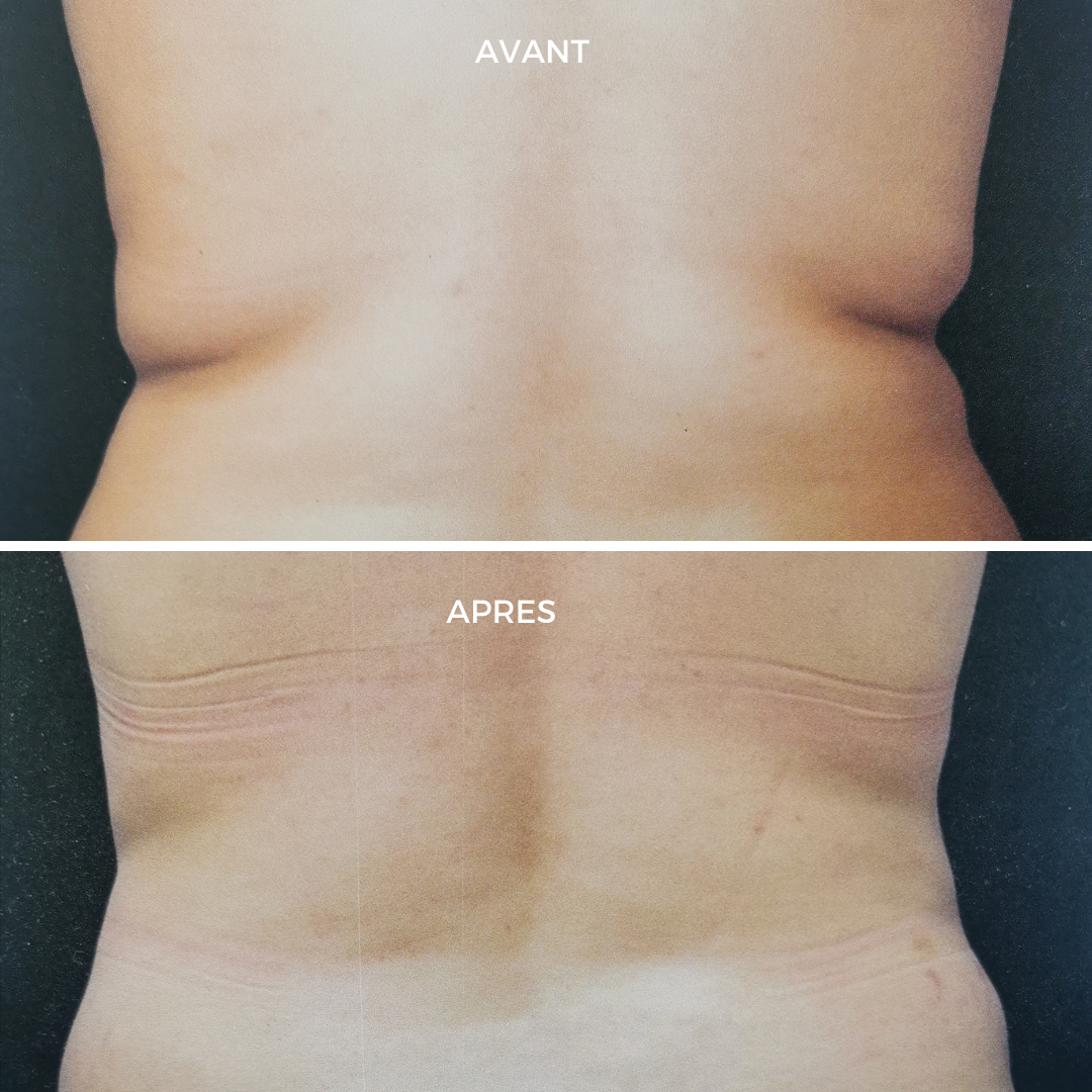 Coolsculpting ventre clinique DEL MAR