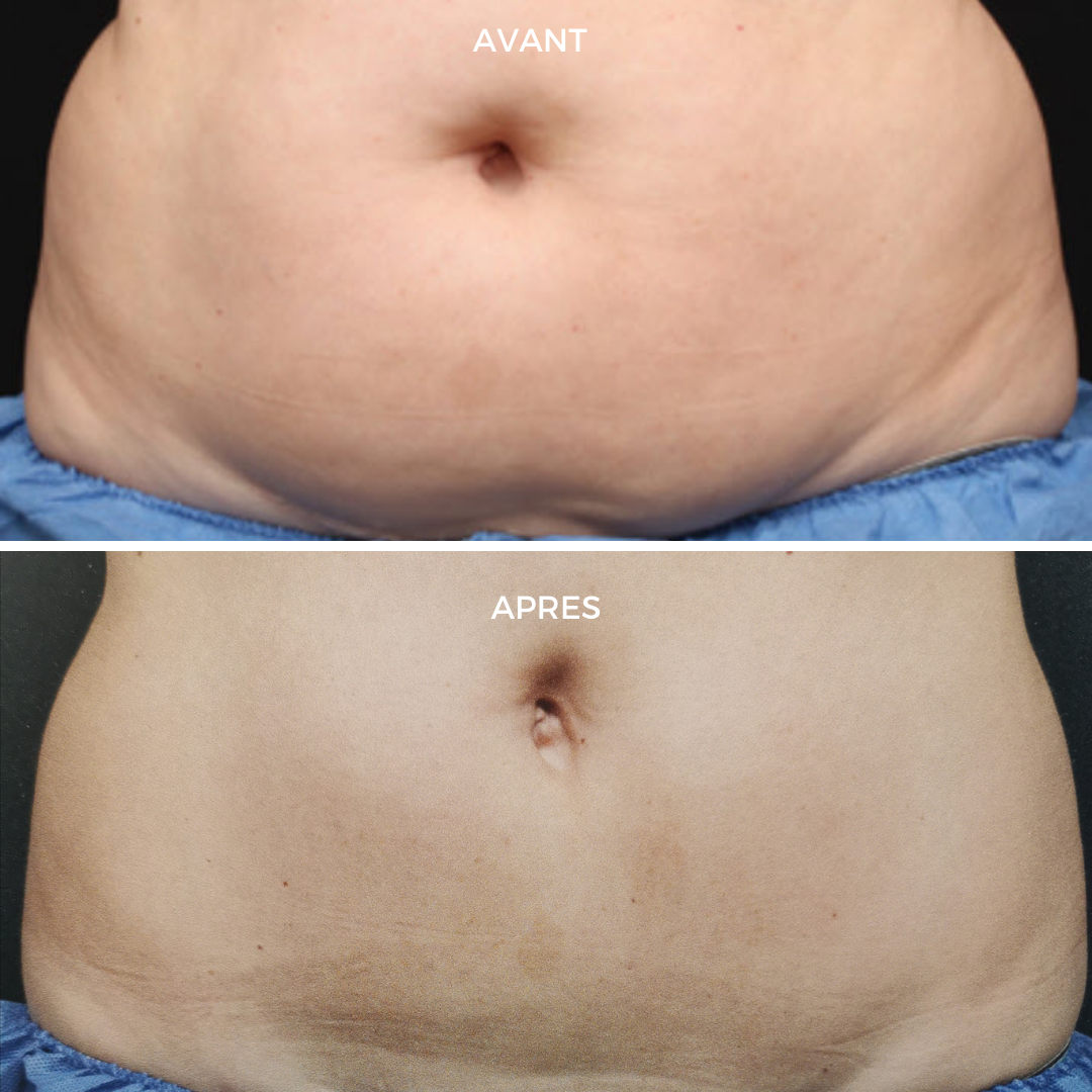 Coolsculpting abdomen clinique DEL MAR